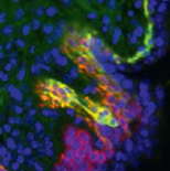 Glycolyse et mort immunogénique