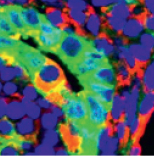 Identification de cellules
progénitrices initiatrices
du carcinome hépatocellulaire